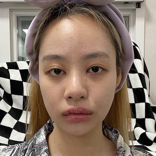 案例9 術前