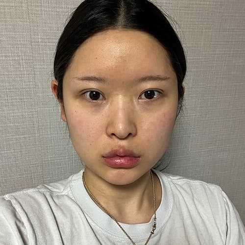 案例11 術前