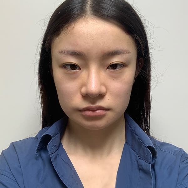 眼整形 術前