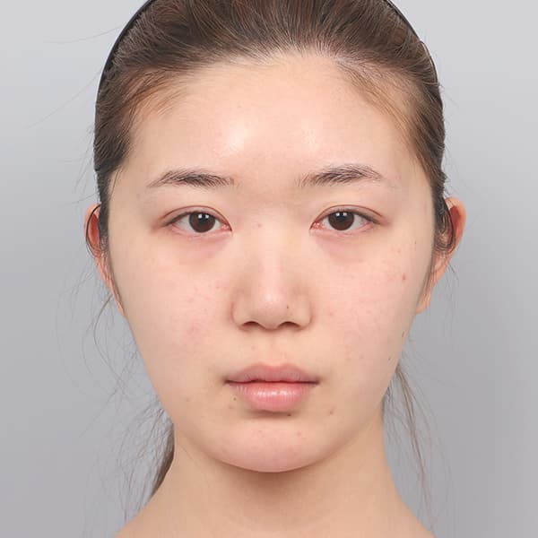 眼整形 術前