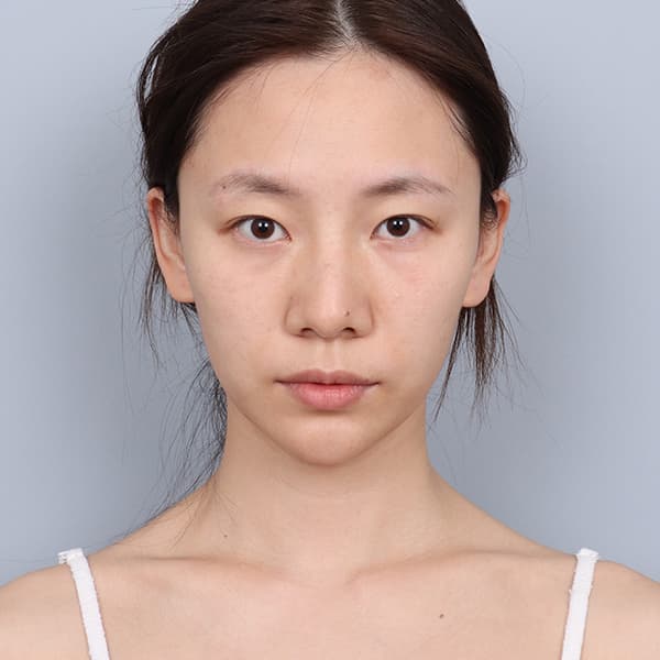 眼整形 術前