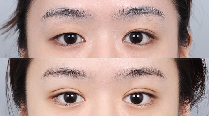 眼整形 術前術後 案例 5