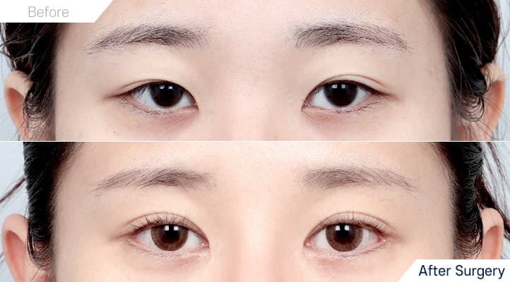 眼整形 術前術後 案例 8