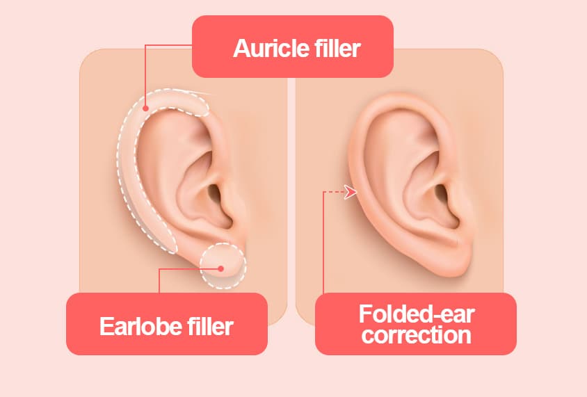Ear Filler