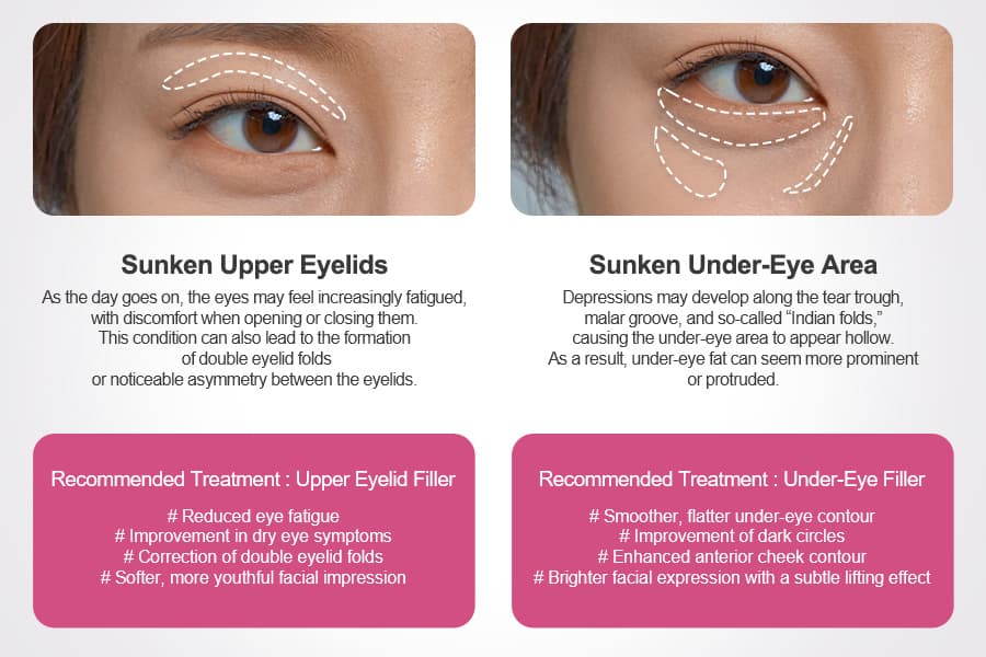 Eye Rejuvenation Filler