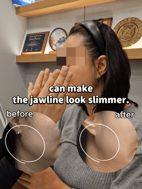 As we enter our 40s, many people start to notice: ✔️ Looser facial contours ✔️ A double chin ✔️ Deeper neck lines Improvement isn’t only about “lifting.” By reducing excess volume, refining the contours, and adding volume only where needed, the overall appearance can change significantly. This case combines: Ultherapy, fat-dissolving injections, Botox, and filler. Not to look unnaturally younger, but to look natural, clean, and refined. We offer facial contouring tailored for your 40s, with a balanced and thoughtful approach. For inquiries and appointments, please contact us via DM or WhatsApp.