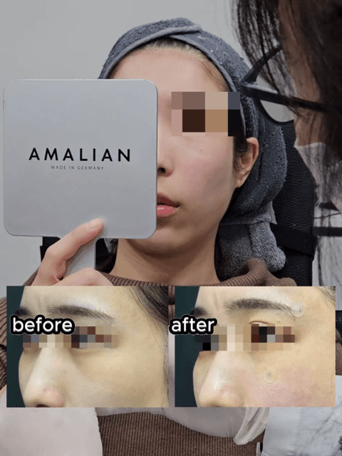 Even without lifting, your look can change this much. By adding only the necessary amount of filler to the temples, lateral cheeks, and chin, and combining chin Botox with Juvelook Eye, we refined the overall balance. Not to look unnaturally younger, but natural and smooth. This is a case that shows how much of a difference filler alone can make. 📩 For consultations and appointments, please contact us via DM or WhatsApp. * Results may vary by individual.