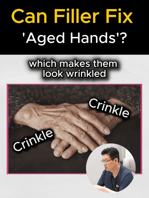 Restore Your Youth: The Magic of Hand Fillers β¨β Do you find yourself hiding your hands because of visible veins, tendons, or wrinkled skin? As we age, we lose volume in our hands, making them look older than we feel. But you don't have to let your hands give away your age! At Gangnam Hera, we provide a professional solution to restore that smooth, youthful look: β
Volume Restoration : Fills in hollow areas where fat has been lost. β
Vein & Tendon Camouflage : Softens the appearance of protruding vessels for a softer look. β
Smooth Texture : Deeply plumps the skin to reduce the "wrinkled" appearance. Experience an instant rejuvenation with natural-looking results. Let your hands match your youthful glow! π