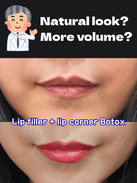✨ Natural Lip Filler in Seoul (Gangnam) ✨ Subtle, balanced, and beautifully tailored to your facial features. At Gangnam HERA Clinic, our lip filler treatments focus on: 💗 Soft volume (not overdone) 💗 Better lip symmetry 💗 A more youthful, refreshed look 💗 Doctor-performed, precision-based results If you’re visiting Korea and looking for a trusted clinic in Gangnam, Seoul, we provide full English support for international patients. 📍Located in Gangnam, Seoul 📩 DM us to book your consultation