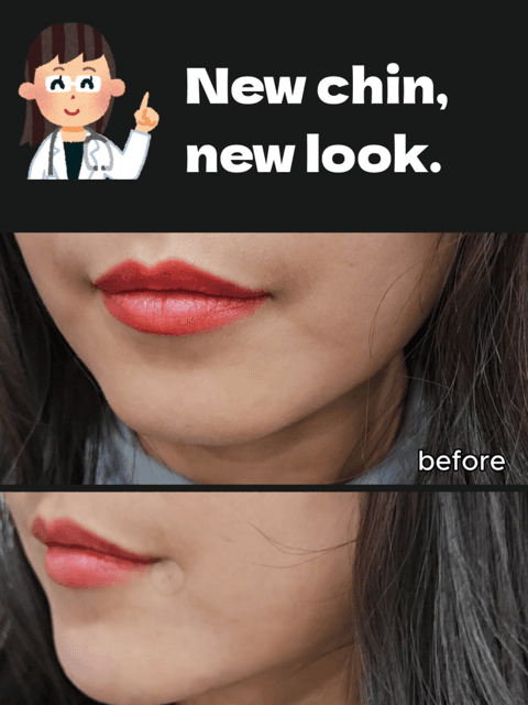 β¨ Chin Filler for Facial Balance β¨ A small change can make a big difference β especially in your side profile. At Gangnam HERA Clinic in Seoul, chin filler is designed to: β Improve facial harmony β Enhance the jawline naturally β Create a softer V-line effect β Support a more defined profile (without surgery) Our treatments are doctor-performed, highly precise, and always tailored to your unique facial structure. If youβre looking for natural chin filler in Gangnam, Seoul, we offer full English support for international patients. πGangnam, Seoul π© DM us for consultation & booking