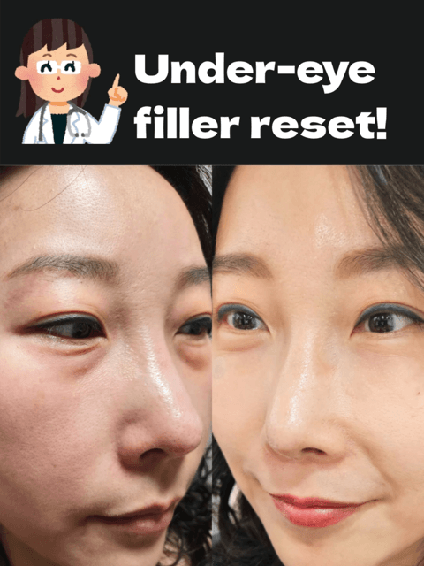 ✨ Under-Eye Filler Correction & Re-Treatment ✨ Sometimes, filler isn’t about adding more — it’s about doing it properly and safely. In this case, the under-eye area required: ✔ Filler dissolving (hyaluronidase) ✔ Careful assessment of the depth and placement ✔ A natural re-treatment for a smoother result The tear trough is one of the most delicate areas of the face, so precision and experience truly matter. At Gangnam HERA Clinic in Seoul, we specialise in: 💎 Under-eye filler correction 💎 Tear trough rejuvenation 💎 Natural, balanced results (never overfilled) If you’re visiting Korea and looking for a trusted clinic in Gangnam, Seoul, we provide full English support for international patients. 📍Gangnam, Seoul 📩 DM us to book a consultation